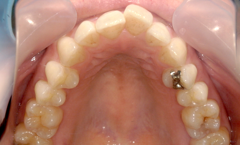 部分矯正 出っ歯の症例写真