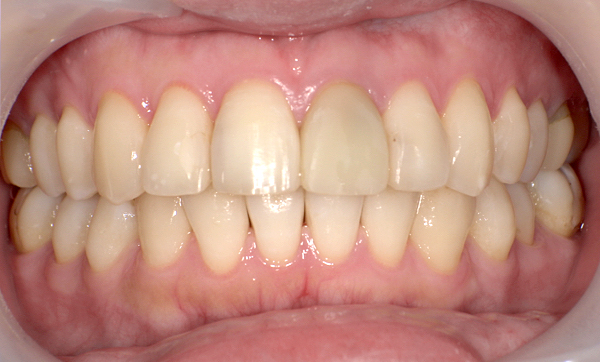 部分矯正 出っ歯の部分矯正の症例写真