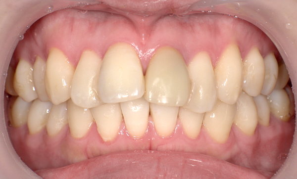 部分矯正 出っ歯の部分矯正の症例写真