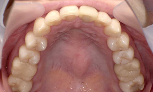 部分矯正 出っ歯の部分矯正の症例写真