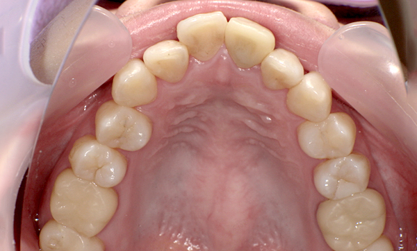 部分矯正 出っ歯の部分矯正の症例写真