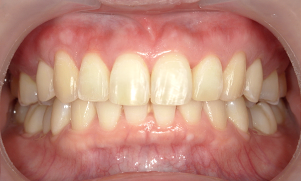 部分矯正 出っ歯の部分矯正の症例写真