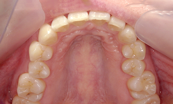 部分矯正 出っ歯の部分矯正の症例写真