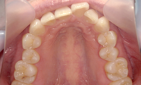 部分矯正 出っ歯の部分矯正の症例写真