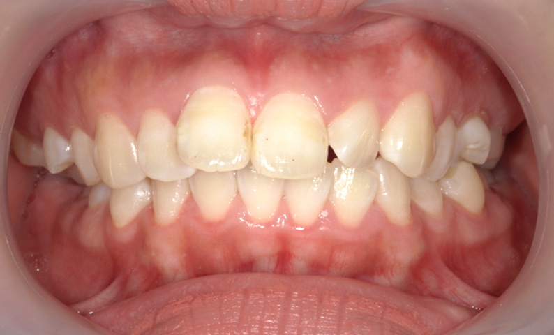 部分矯正 出っ歯の部分矯正の症例写真