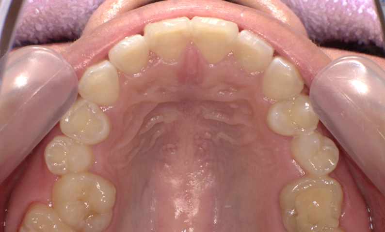 部分矯正 出っ歯の部分矯正の症例写真