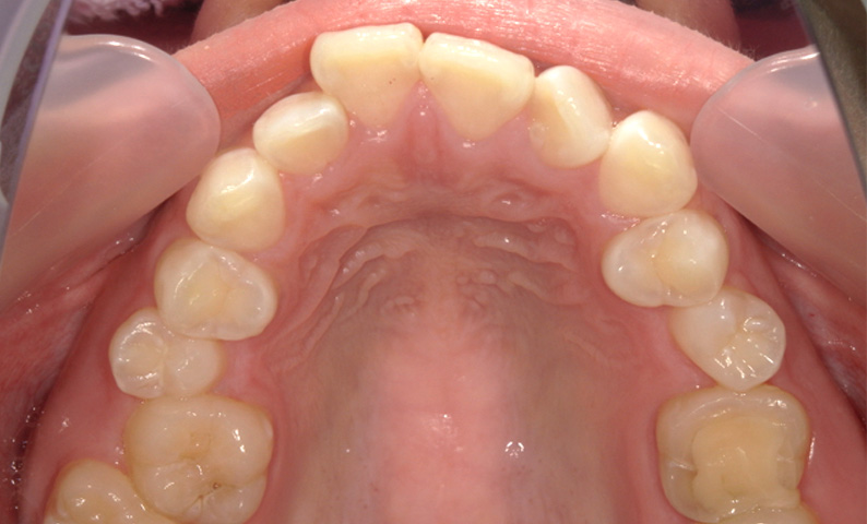 部分矯正 出っ歯の部分矯正の症例写真