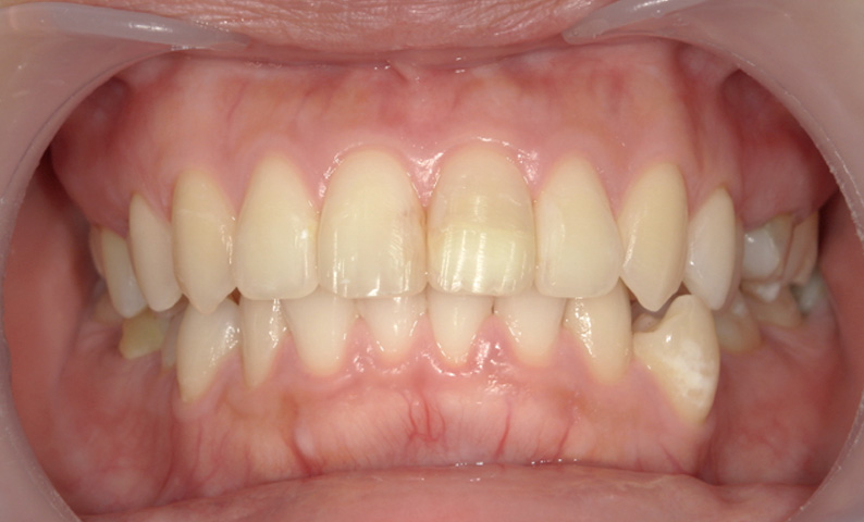 部分矯正 出っ歯の部分矯正の症例写真