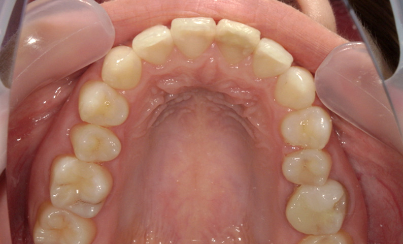 部分矯正 出っ歯の部分矯正の症例写真