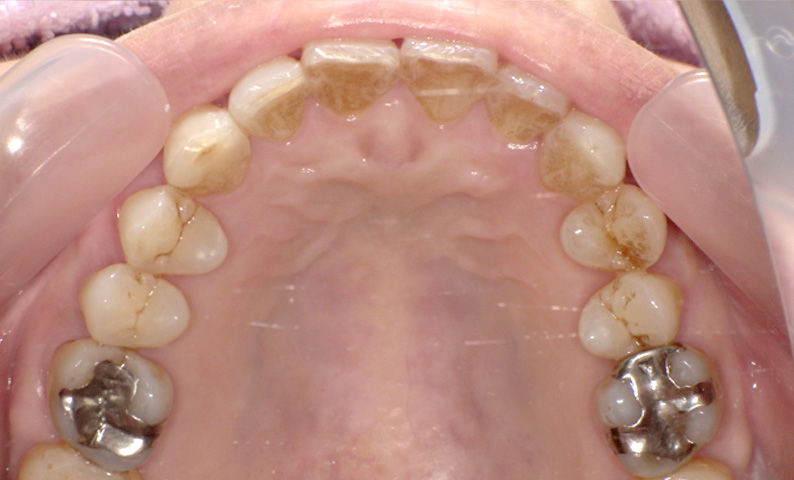 部分矯正 出っ歯の部分矯正の症例写真