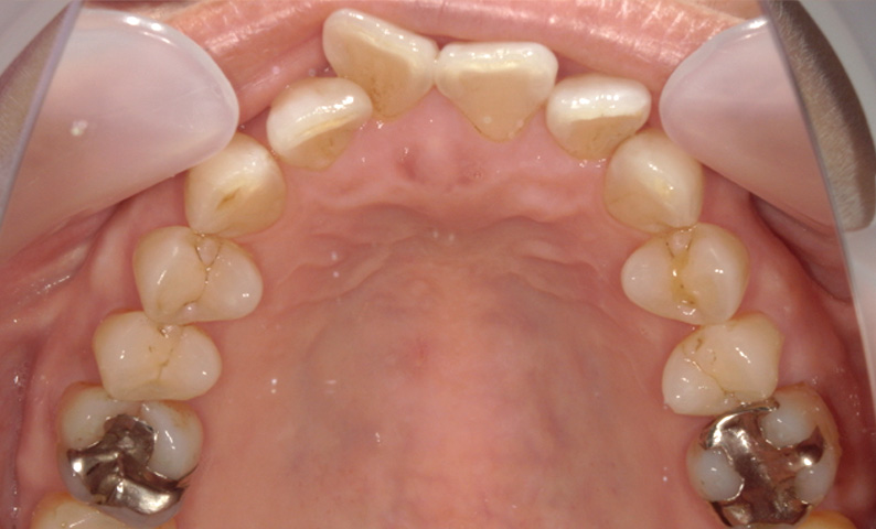 部分矯正 出っ歯の部分矯正の症例写真