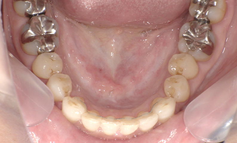 部分矯正 出っ歯の部分矯正の症例写真
