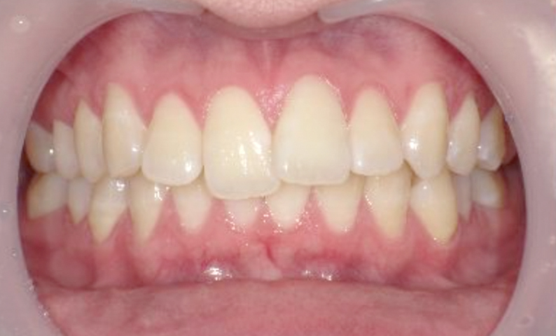 「前歯1本だけ」部分矯正の症例