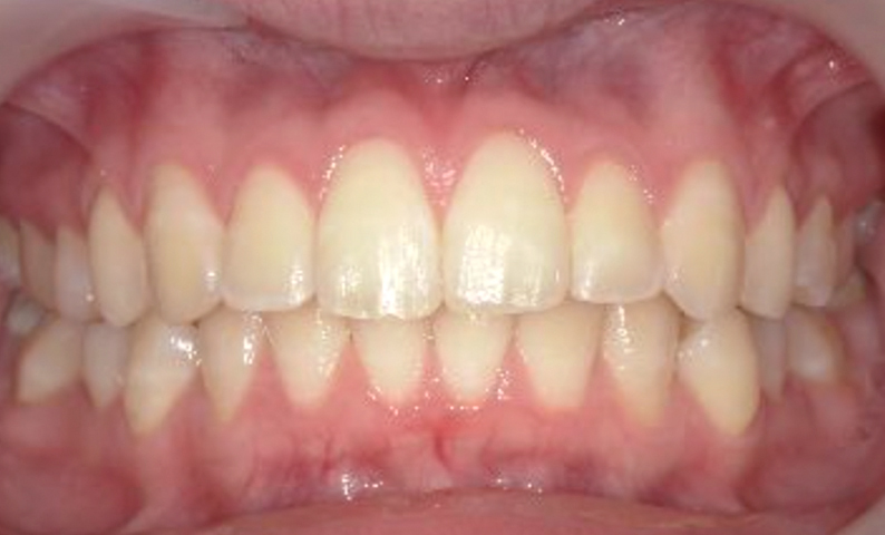 「前歯1本だけ」部分矯正の症例