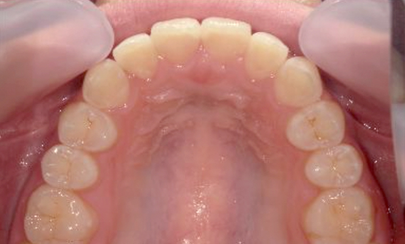 「前歯1本だけ」部分矯正の症例