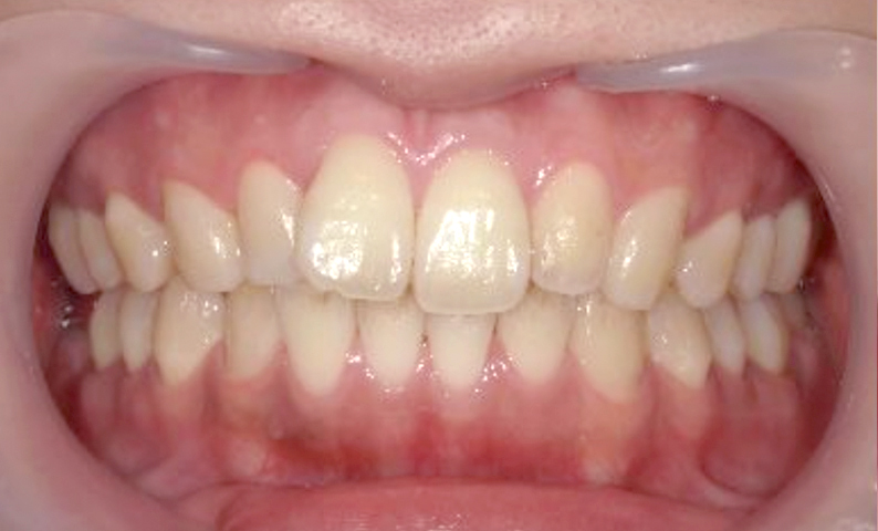 「前歯1本だけ」部分矯正の症例