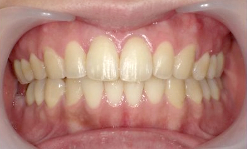 「前歯1本だけ」部分矯正の症例