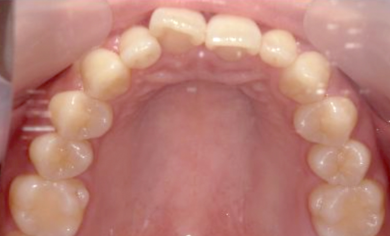 「前歯1本だけ」部分矯正の症例