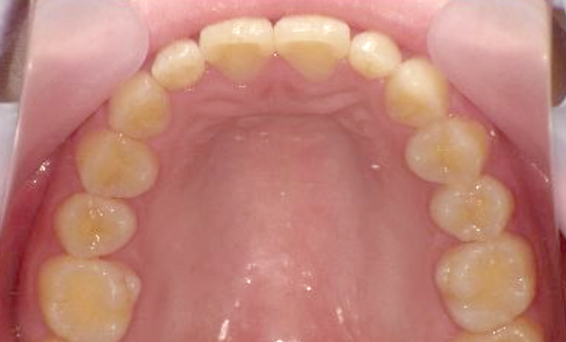 「前歯1本だけ」部分矯正の症例