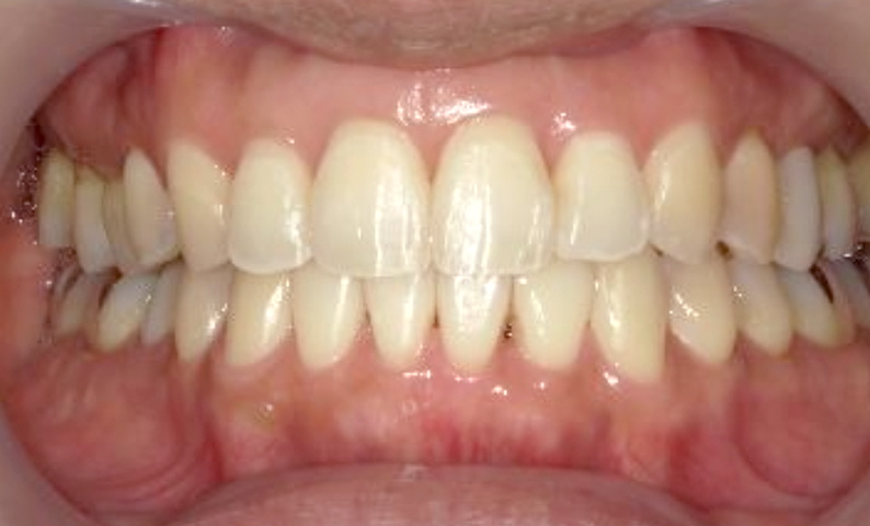 「前歯1本だけ」部分矯正の症例