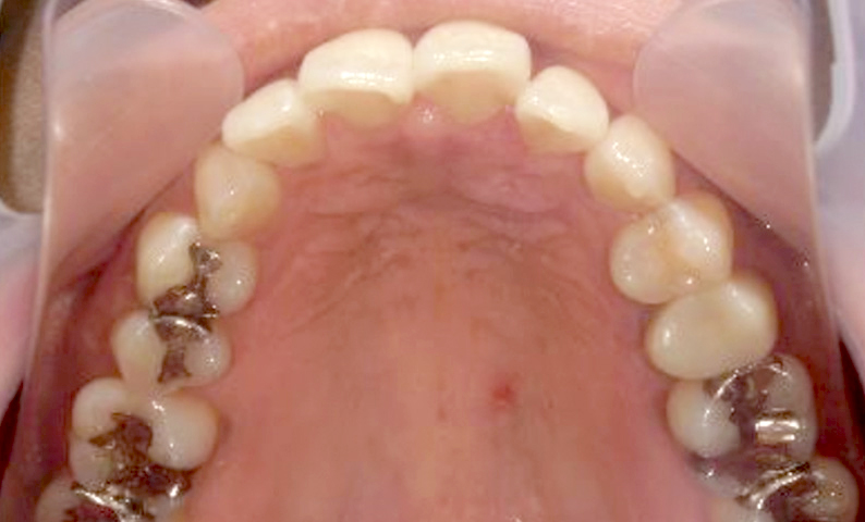 「前歯1本だけ」部分矯正の症例