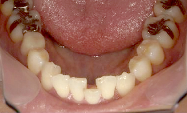「前歯1本だけ」部分矯正の症例