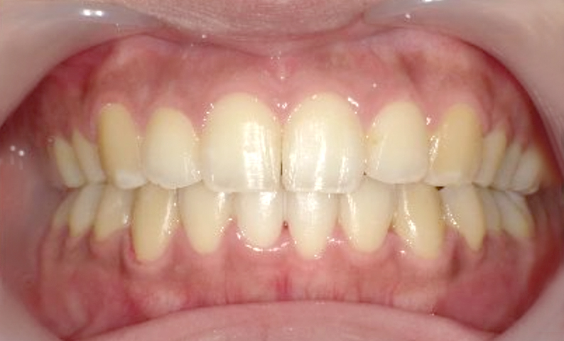 「前歯1本だけ」部分矯正の症例