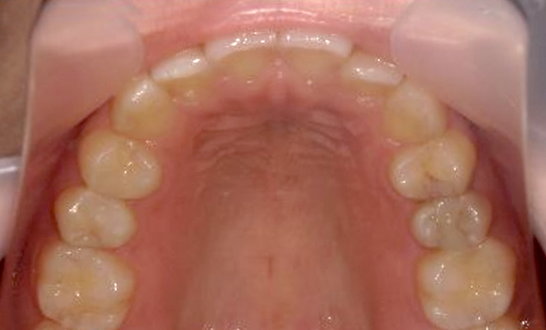 「前歯1本だけ」部分矯正の症例
