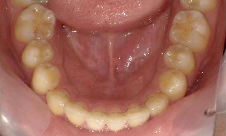「前歯1本だけ」部分矯正の症例