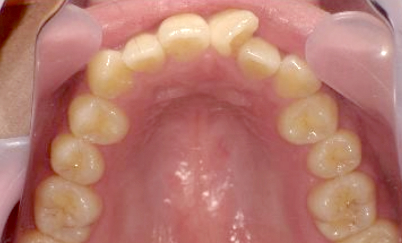 「前歯1本だけ」部分矯正の症例