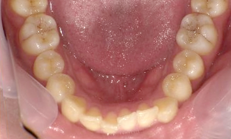 「前歯1本だけ」部分矯正の症例