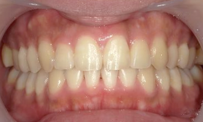 「前歯1本だけ」部分矯正の症例