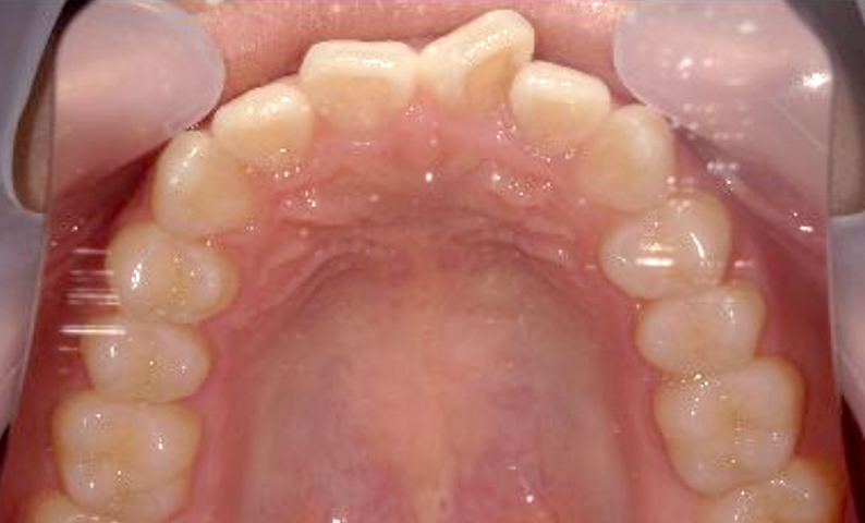 「前歯1本だけ」部分矯正の症例