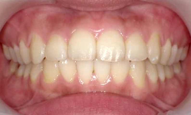 「前歯1本だけ」部分矯正の症例