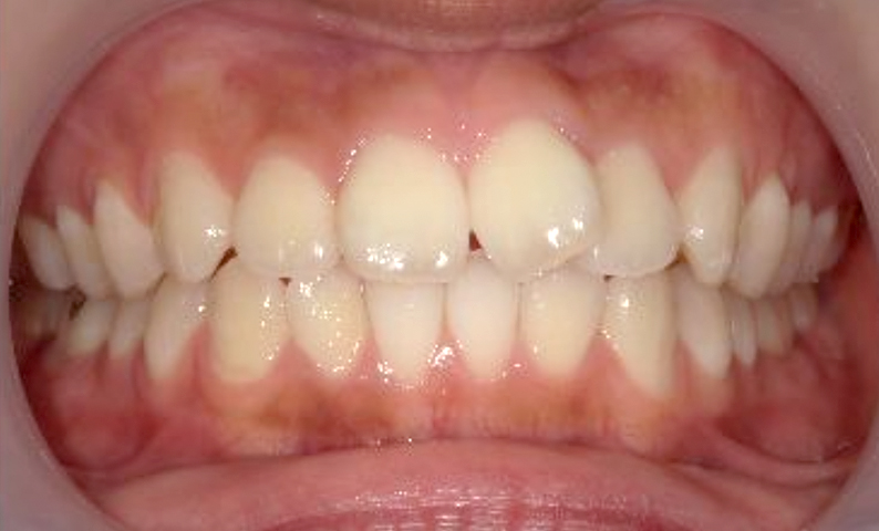 「前歯1本だけ」部分矯正の症例