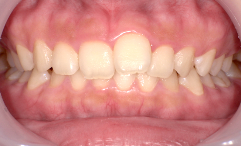 「前歯1本だけ」部分矯正の症例