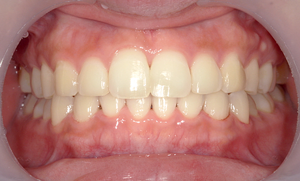 「前歯1本だけ」部分矯正の症例