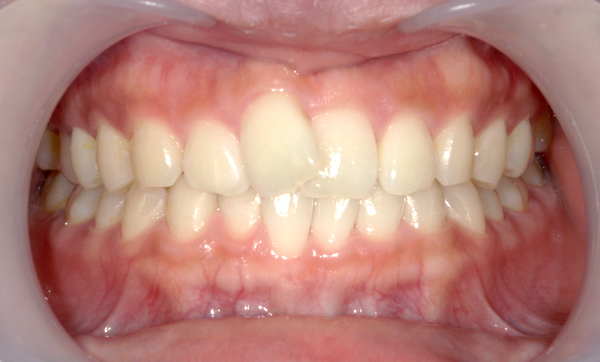 「前歯1本だけ」部分矯正の症例