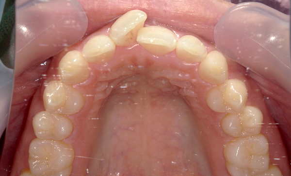 「前歯1本だけ」部分矯正の症例