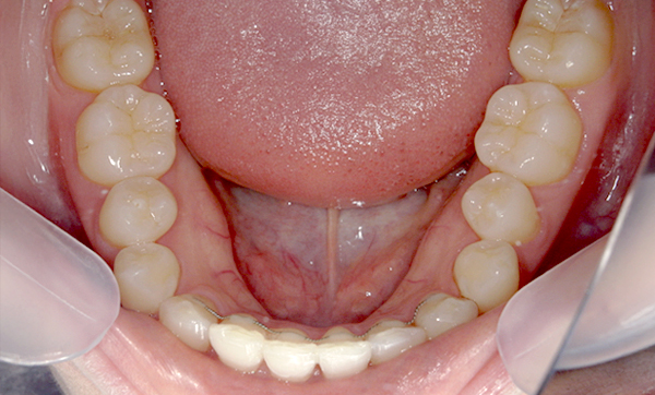 「前歯1本だけ」部分矯正の症例