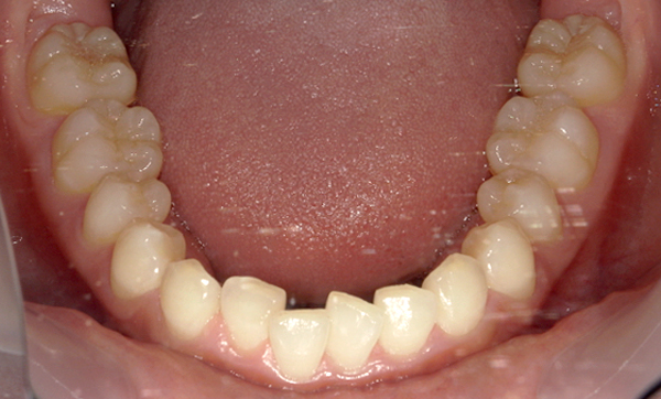 「前歯1本だけ」部分矯正の症例