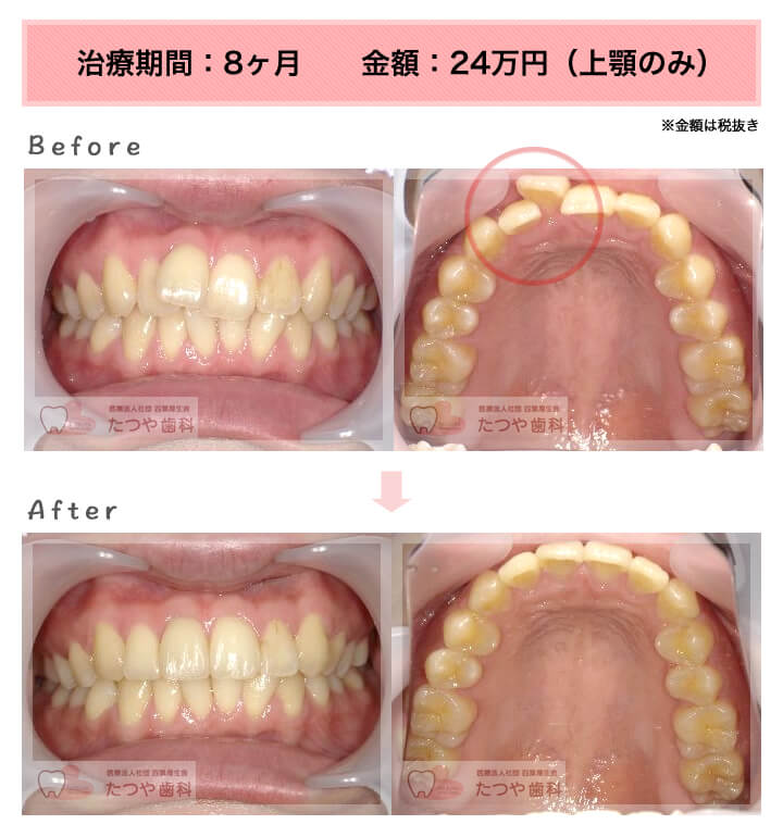 「前歯1本だけ」部分矯正の症例