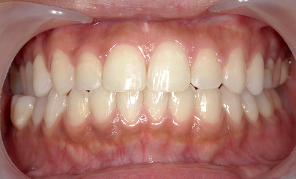 「前歯1本だけ」部分矯正の症例