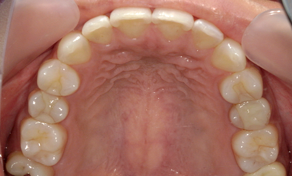 「前歯1本だけ」部分矯正の症例