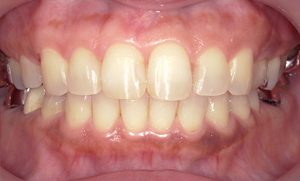 「前歯1本だけ」部分矯正の症例
