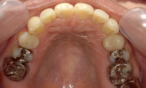 「前歯1本だけ」部分矯正の症例