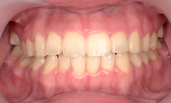 「前歯1本だけ」部分矯正の症例