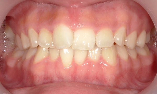 「前歯1本だけ」部分矯正の症例