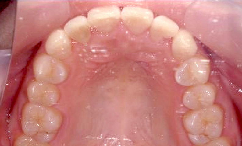 部分矯正 上下の部分矯正の症例写真