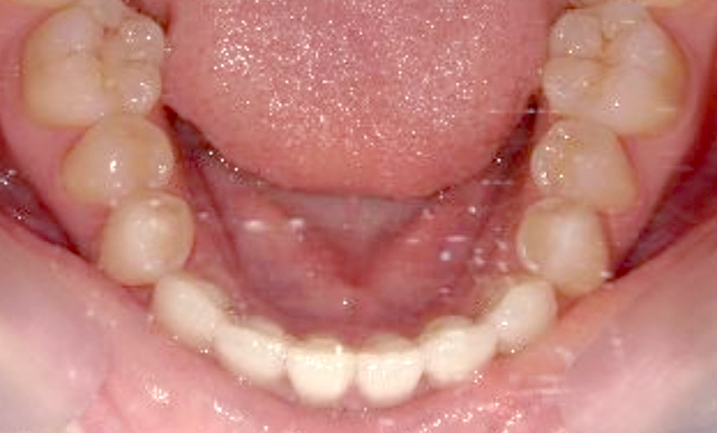 部分矯正 上下の部分矯正の症例写真